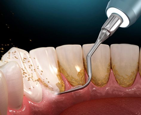 Periodoncia